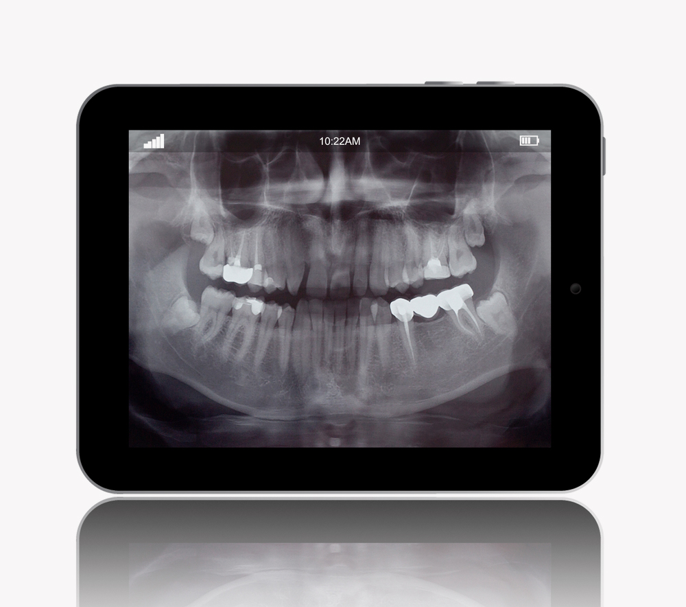 Zahnarzt , Dentalhygiene , Zahnspange , Implantat , Günstige Implantate